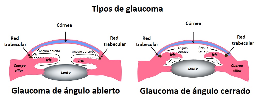 GLAUCOMA, te puedes quedar ciego, tómalo en serio