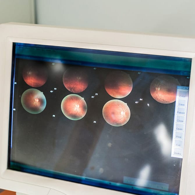 Imágenes de retinografía en un monitor