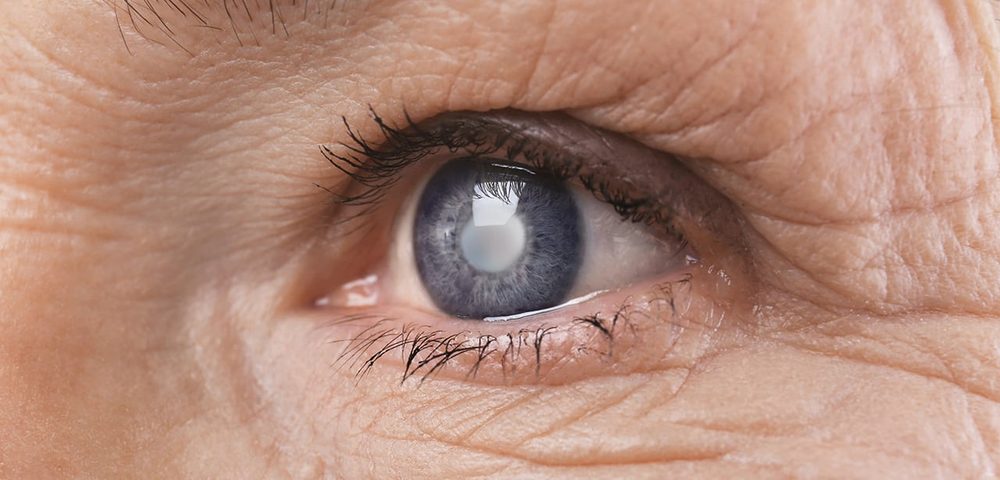 Primer plano de un ojo con cataratas